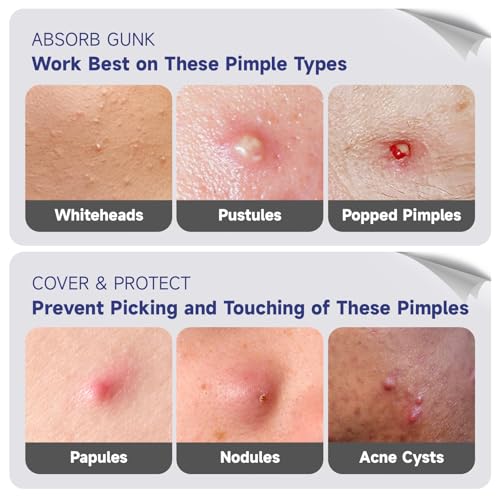 Save 40% on Cute Star Pimple Patches with Code XEJ74WSA - Image 5