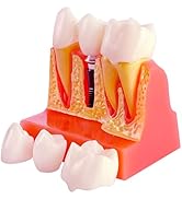 Dental Implant Model with Removable Crown Bridge - 4 Times Enlarged Demonstrative Teeth Model for...