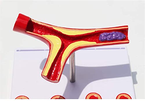 Anatomie Model, Educatief Model Anatomie Atherosclerose Model Trombus Trombose Vasculair Model Arterieel Bloedvat… - Image 6
