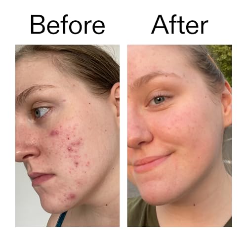 Image of The INKEY List 10% Glycolic Acid Toner 3.4 Fl Oz, Includes Witch Hazel, Pore Minimising Toner, Brightens Skin, Vegan Friendly, Suitable for Normal /Oily Skin