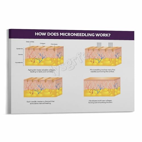 How Does Microneedling Work Anti-Aging Skin Regeneration Infographic Poster Canvas