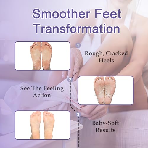 Foot Peeling Mask 5 Pack – Exfoliator & Foot Callus Remover – Feet Peeling Mask for Cracked Heel Treatment – Foot Masks for Dry Cracked Feet, Soft & Smooth Finish with Urea, Lavender & Salicylic Acid