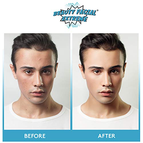 Acne Spot Treatment Serum - Quickly Fights And Treat Acne Breakouts, Pimples, Whiteheads & Blackheads. Dissolves Away Pore Clogging Oils Without Over Drying Your Skin. #TOP3