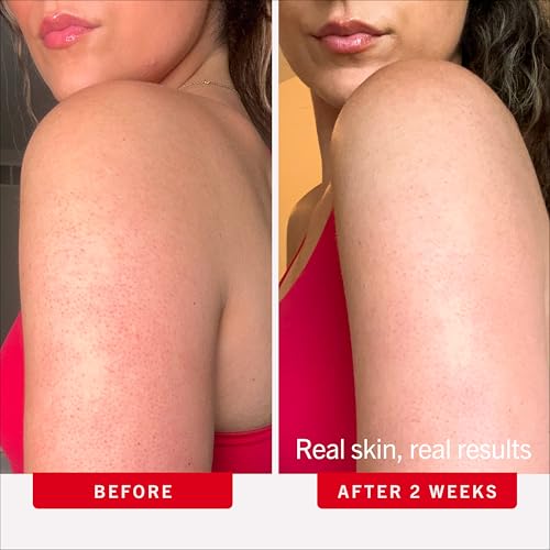 Image of First Aid Beauty KP Bump Eraser Body Scrub with 10% AHA - Dermatologist-Tested Keratosis Pilaris Exfoliator - Support for Rough Bumps, Uneven Skin Texture & Strawberry Skin - Sensitive Skin
