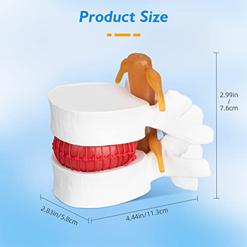 Image of Disc Herniation Model - 1.5X Lumbar Herniated Disc Model Vertebral Spine Anatomical Medical Model