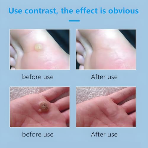 Image of Wart Remover Cream with Salicylic Acid, Freeze Off Fast-Acting Wart Remover Ointment for Warts, Plantar Warts, Common Warts, Flat Warts, Corns, Calluses