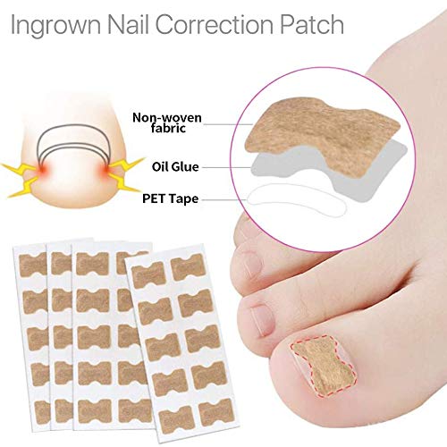 Juego de 5 parches de uñas sin pegamento – Kit de herramientas encarnadas para uñas de los pies para tratamiento de uñas, herramienta de corrección de uñas encarnadas para eliminar las uñas de los pies remiendo profesional para mantener las uñas saludable 5