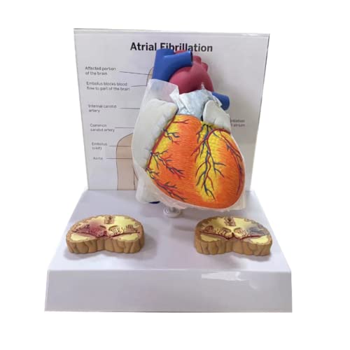 Lsoaarrt Atrial Fibrillation Human Education Heart Anatomical Model
