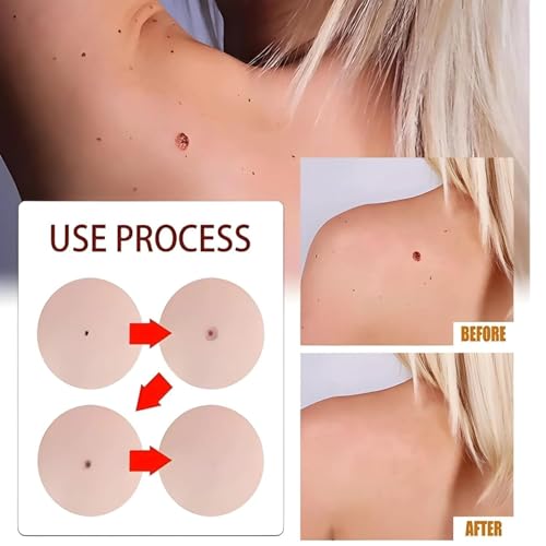Image of Pack of 2 Wart, Ointment, Skin Tags & Moles Remover For Face & Body | Massa & Ointment Remover For All Skin | Skin Tag Remover - Fast, Easy & Effective Formula for All Skin Type (2 Units)