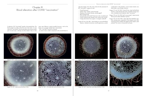 Corona Blood Phenomena: Microscopic Examinations of Blood, Serum, and Cerebrospinal Fluid: Healthy -