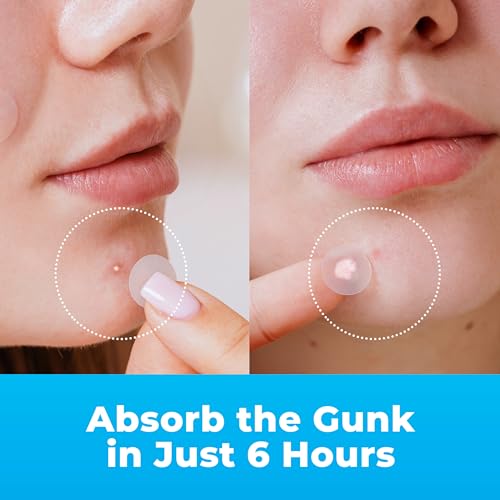 PatchRx Pimple Patches for Face (240 Patches), Hydrocolloid Acne Patches with Tea Tree Oil, Pimple Stickers - Acne Pimple Patches For Face - Zit Patches