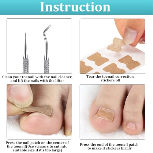 Image of 101 /102pcs Ingrown Toe Nail Remover, Toenail Corrector Strips and Ingrown Toenail Correction Tool, for Daily Nail Care and Post-Exercise Maintenance (101 PCS Brown)