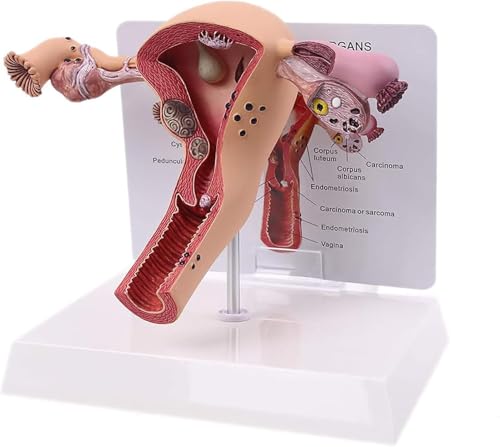 JINLEXIU Female Uterus Ovary Model, Pathology Model of Human Female Uterus Ovary Disease Dissection Biology Teaching Aid Anatomy Lesion Uterus - Thumbnail 3