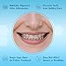 Hawley Retainers for Adults, Custom Retainers for Upper and Lower Teeth - Comfortable and Durable