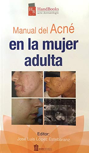 Acné en la mujer adulta: Handbook Dermatología