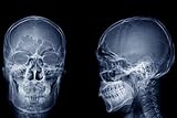 Human Skull X-ray Image Front and Side Lateral View Skeleton Anatomy Medical Photo Cool Wall Decor Art Print Poster 12x18