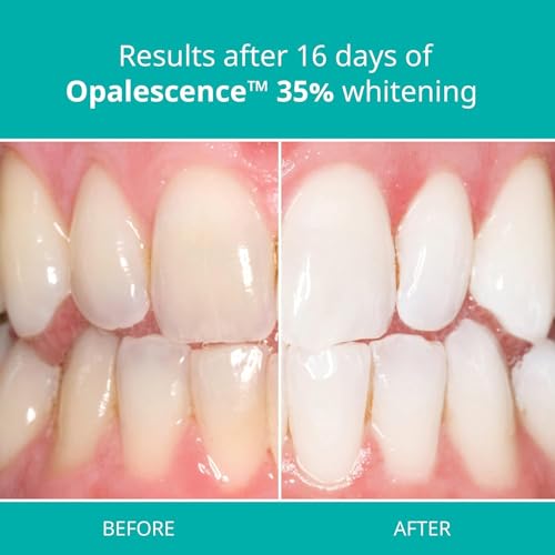 Ultradent Opalescence 35% PF Tooth Whitening Refill Kit, A-5197-2