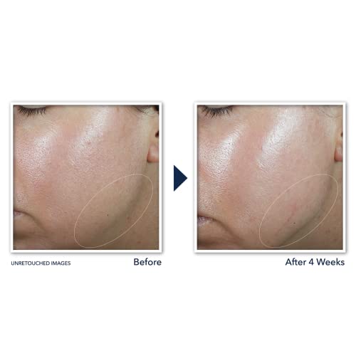 Roc Derm Correxion Neck Cream With Hyaluronic Acid And Advanced Retinol To Visibly Tighten & Lift Horizontal Neck Lines, Facial Moisturiser To Contour Face, Neck And Jawline, 1.7Oz #TOP3