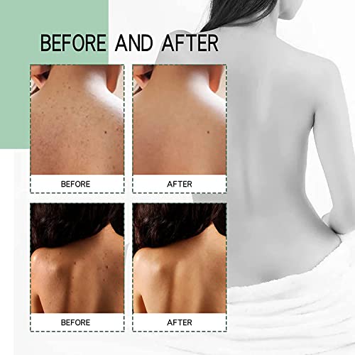 Herbaluxy Back Acne - Back Acne Treatment Spray, Salicylic Acid Body Acne Spray, Back Exfoliator For Shower (2Pcs) #TOP6