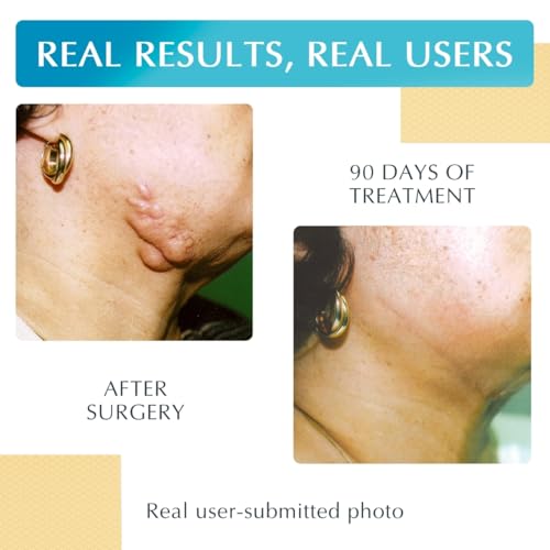 Advanced Silicone Scar Treatment Sheets for OLD, NEW Scars, Surgery, Keloids, C-Section, Burns, by NewGel Plus by MyNewGel, 1" x 6" Sheet (4 Count) - BEIGE