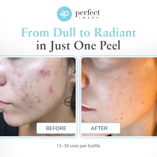 Glycolic Acid 30% Gel Peel - Enhanced with Retinol and Green Tea Extract (Professional Chemical Peel)- 1 fl oz 30mL