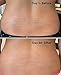 ReTone Stretch Mark Removal Cream: Prevention and Treatment of old and new stretch marks and scars