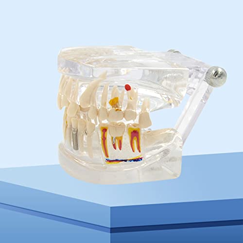 Modèle de dents transparent avec implants amovibles pour cabinet dentaire et étude - 4