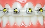 Snapcaps Braces Bumper Cover, Orthodontic Bracket Wax Substitute, Alternative Snap-on Braces Guard Braces Accessories 10 pack (Smiley Face)