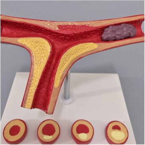Modelo de arteriosclerosis humana para resolver dudas visuales en cardiología 2