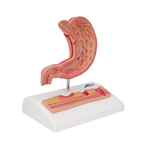 Image of 3B Scientific K17 Stomach w / Ulcers - 3B Smart Anatomy