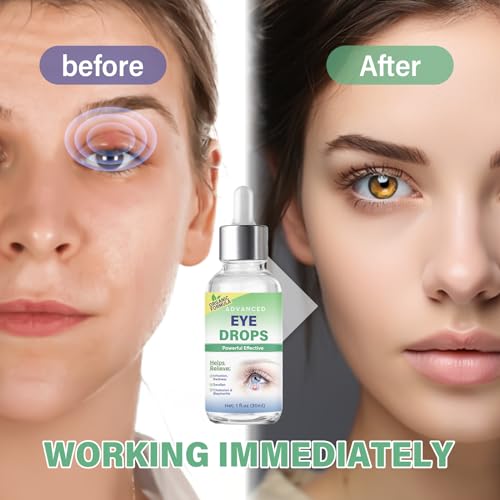 HOUNE Stye Eye Treatment, Stye Eye Drops Serum for Styes Chalazion and Blepharitis, Chalazion Remover Fast Relief, Restore Healthier Eye Skin, 30ml
