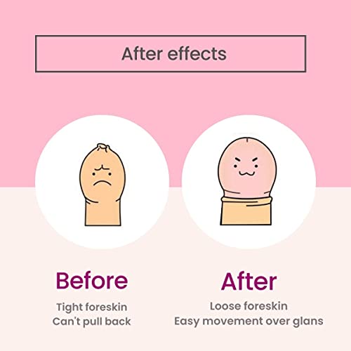 Image of Vajraang phimosis stretching rings with fore-stretch cream, tool and user guide