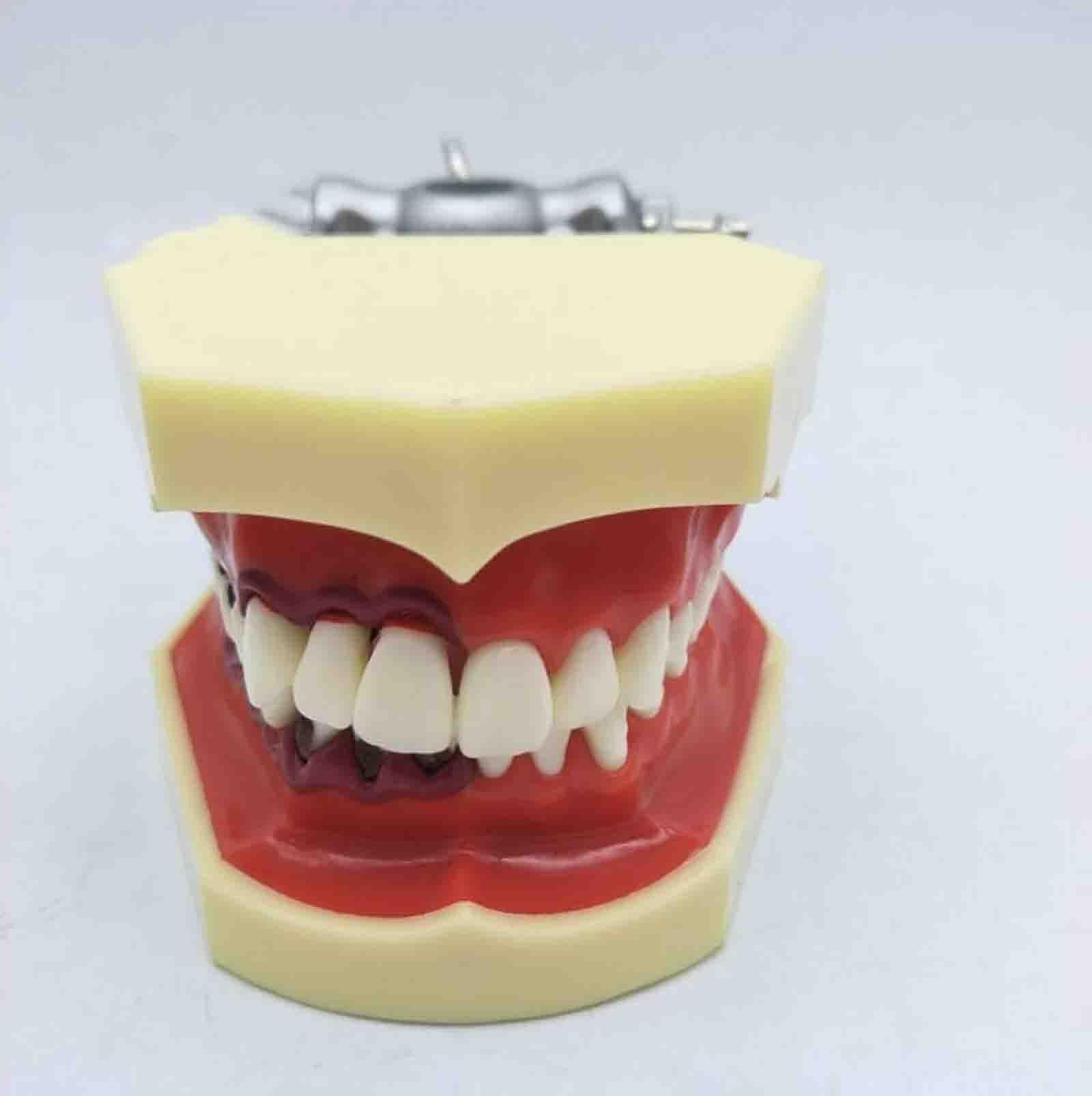 Model patologii przyzębia – kamień nazębny | Model dentystyczny typu typodont – zęby wkręcane – metalowy uchwyt