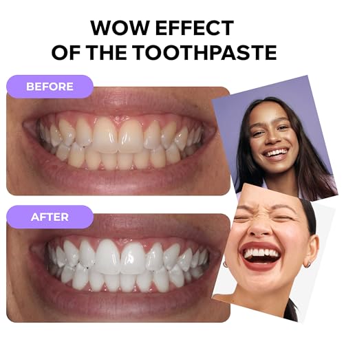 Image of Teeth Whitening Foam with Purple Color Correcting Technology - 50ml Gentle Formula for Daily Use, Stain Removal, Mint Flavor, Safe for Sensitive Teeth, Enamel-Friendly Whitening