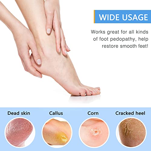 Sptcckare Foot File, Double Sided Pedicure Foot Scrubber Scraper Callus Remover, Foot Rasp For Cracked Heel And Foot Corn Removal, Dead Skin Exfoliator For Feet (Pink) #TOP2