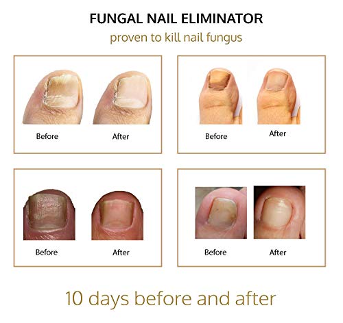 Nail & Toenail Fungus Treatment - Fungal Nail Eliminator with Tolnaftate formulated by Physician to Cure Athlete's Foot Therapy & Infected Toe Nails Fungus, Best Anti-fungal Finger-nail Treat-ment - Thumbnail 7