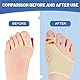 gelpretty 1 Paar Hallux Valgus Socken Korrektur für den Großen Zeh,Hammerzeh Korrektur und Schutz,Hallux Valgus mit Silikonpads für Herren und Damen Schutz der großen Zehe,Universalgröße