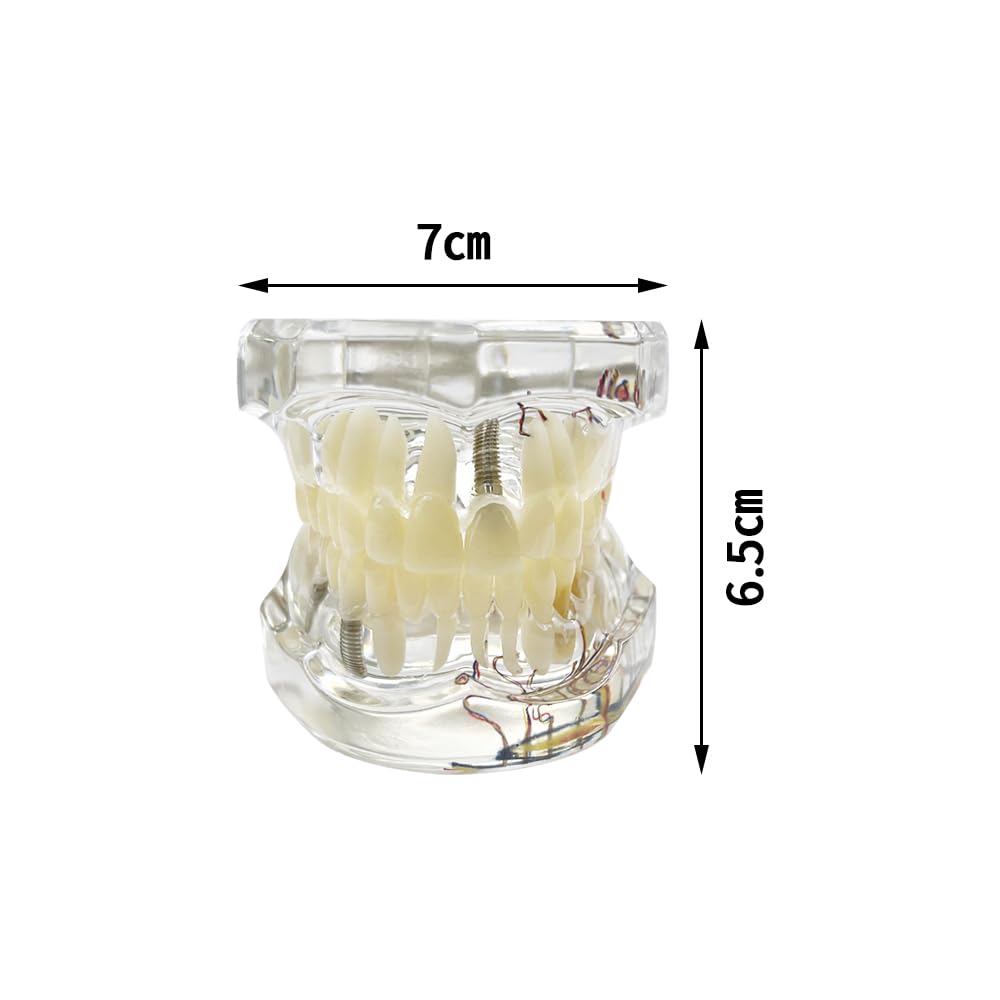 Modello dentale di riparazione neurale Modello dentale Malattia dell'impianto Modello dei denti Dentista Modello di insegnamento patologico standard dei denti rimovibili