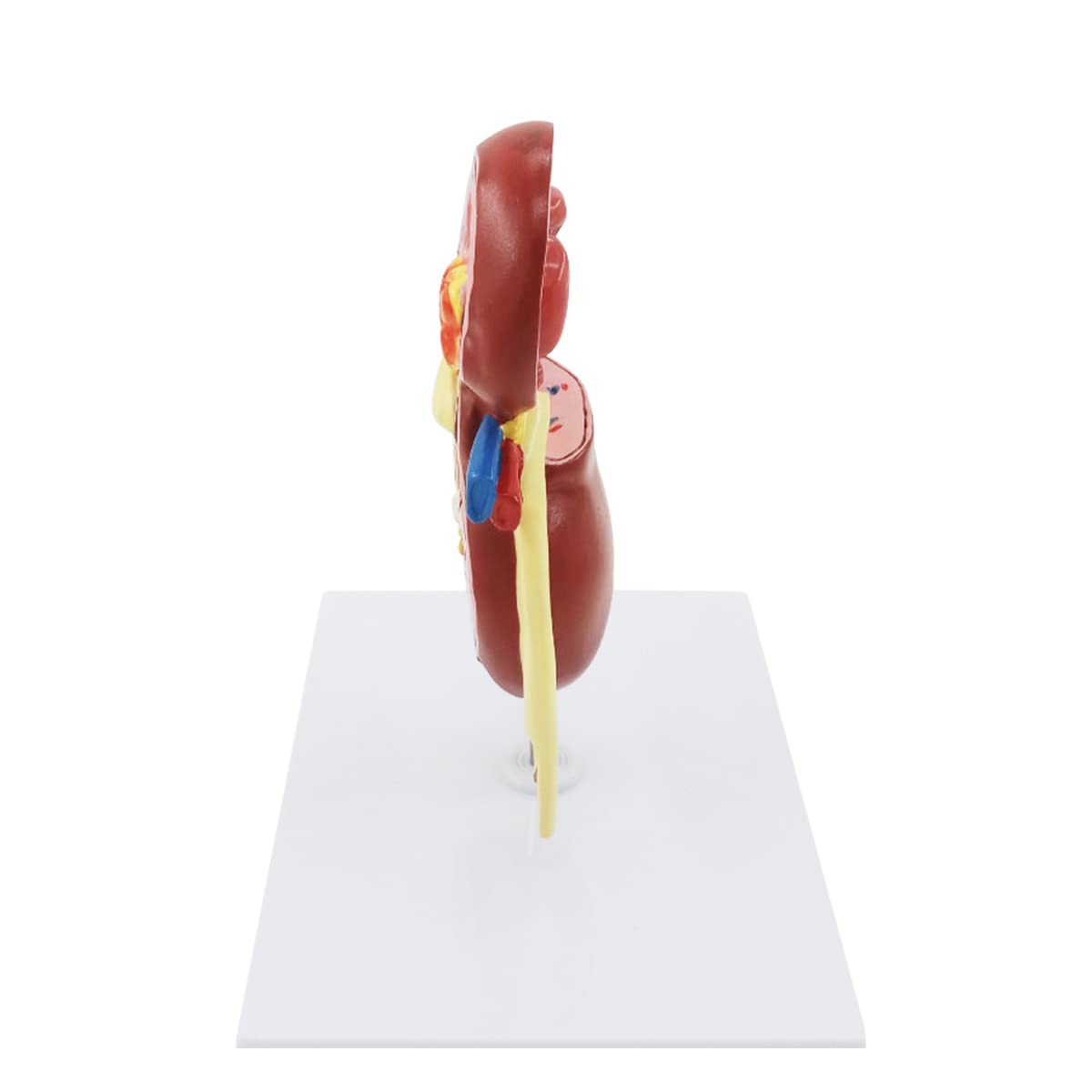 Pathologisches Modell, menschliches Nierenläsionsmodell, Anatomie, pathologisches Steinorgan, Nierensteine, Urologie, Nierenmodell für medizinische Lehr-/Bildungsbedarf