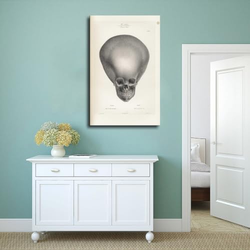 Impression sur toile crâne d'hydrocéphalie Joseph Vimont 50x75 cm - 4
