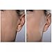 Spa Sciences SIMA DELUXE - Dermaplaning Tool for Painless Facial Exfoliation & Peach Fuzz Removal - 14 Weeks of Treatment Included