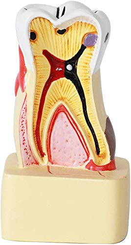 Dental Model of Dental Caries, Tooth decay amplification of pathological anatomical model of caries for Students of the Medical School
