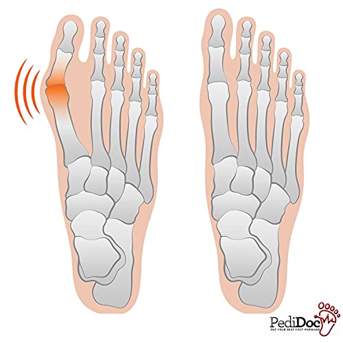 Bunion Corrector and Bunion Relief Sleeves Kit - Hallux Valgus Bunion Protector - Bunion Toe Separator, Toe Spacer, Toe Straightener and Toe Spreader - 7 Pieces - Thumbnail 7