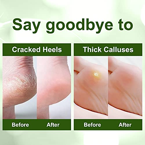 Foot Peel Mask 5 Pack Foot Mask For Dry Cracked Feet Dead Skin Avocado Silky Feet Mask Natural Foot Mask Peel Exfoliating Foot Mask Socks Bulk Make Your Feet Baby Soft Gift For Women& Men #TOP2