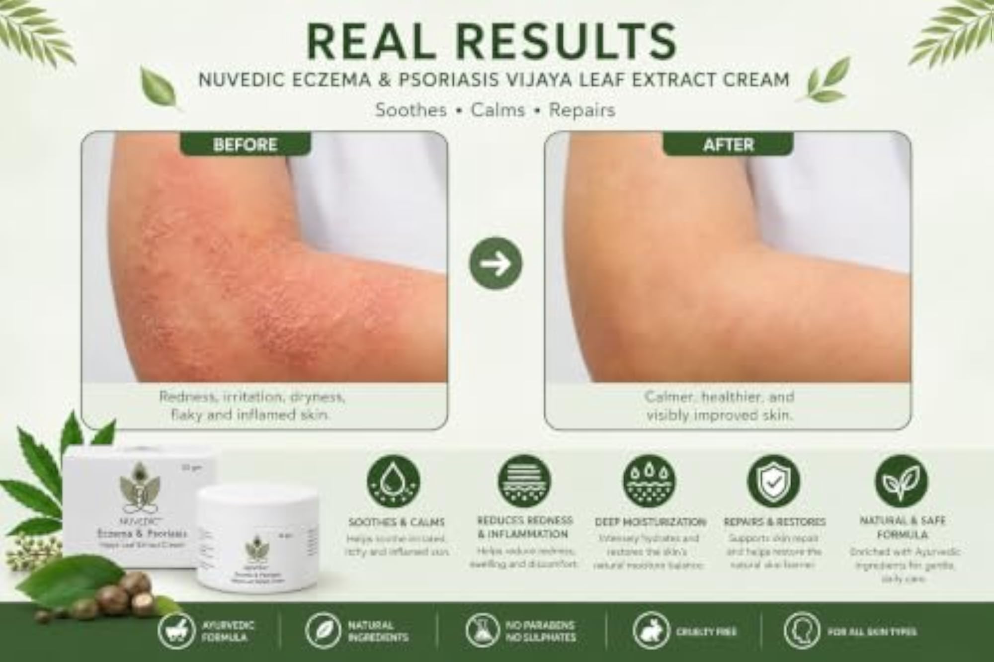 Eczema Relief Ayurvedic Cream with Aloe Vera & Hemp Seed Oil