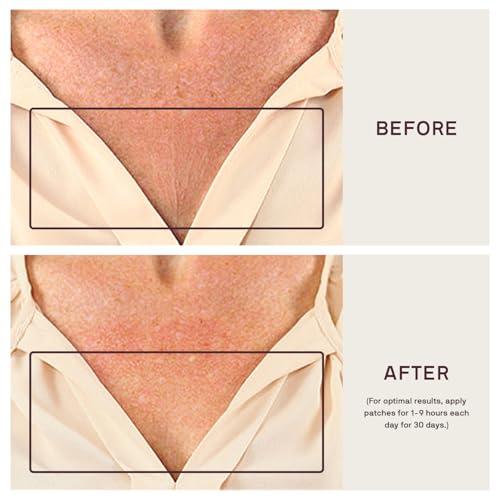 Dermaclara Patch de rugas no peito – adesivos de silicone para rugas, almofadas reutilizáveis para r