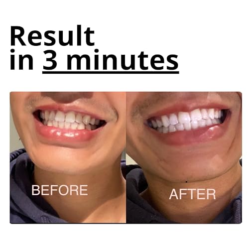 Image of Teeth Whitening Foam with Purple Color Correcting Technology - 50ml Gentle Formula for Daily Use, Stain Removal, Mint Flavor, Safe for Sensitive Teeth, Enamel-Friendly Whitening