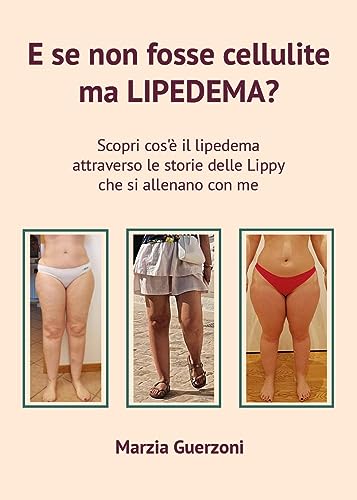 E se non fosse cellulite ma lipedema?
