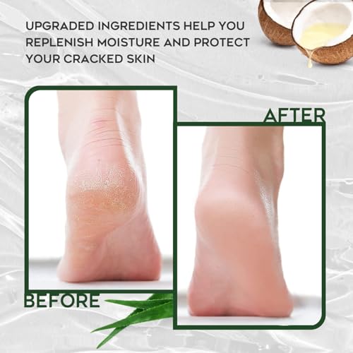 Urea Cream 42% Foot Cream Salicylic Acid 4 Oz, Upgraded Callus Remover For Feet, Knees& Elbows, Intensive Moisturizes & Softens Skin, Exfoliates Dead Skin