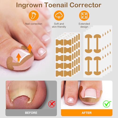 Ingrown Toenail Corrector Set with Correction Strips, Ingrown Toenail Removal Kit, Professional Ingrown Toenails Pedicure Tool Set (Silver) — view 4